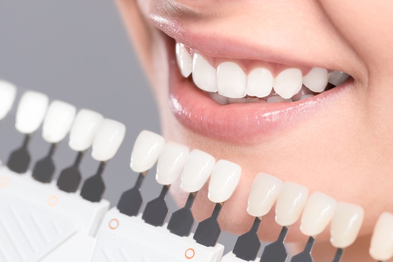 3 Reasons To Get Teeth Whitening Service From An Illinois Dental Practice